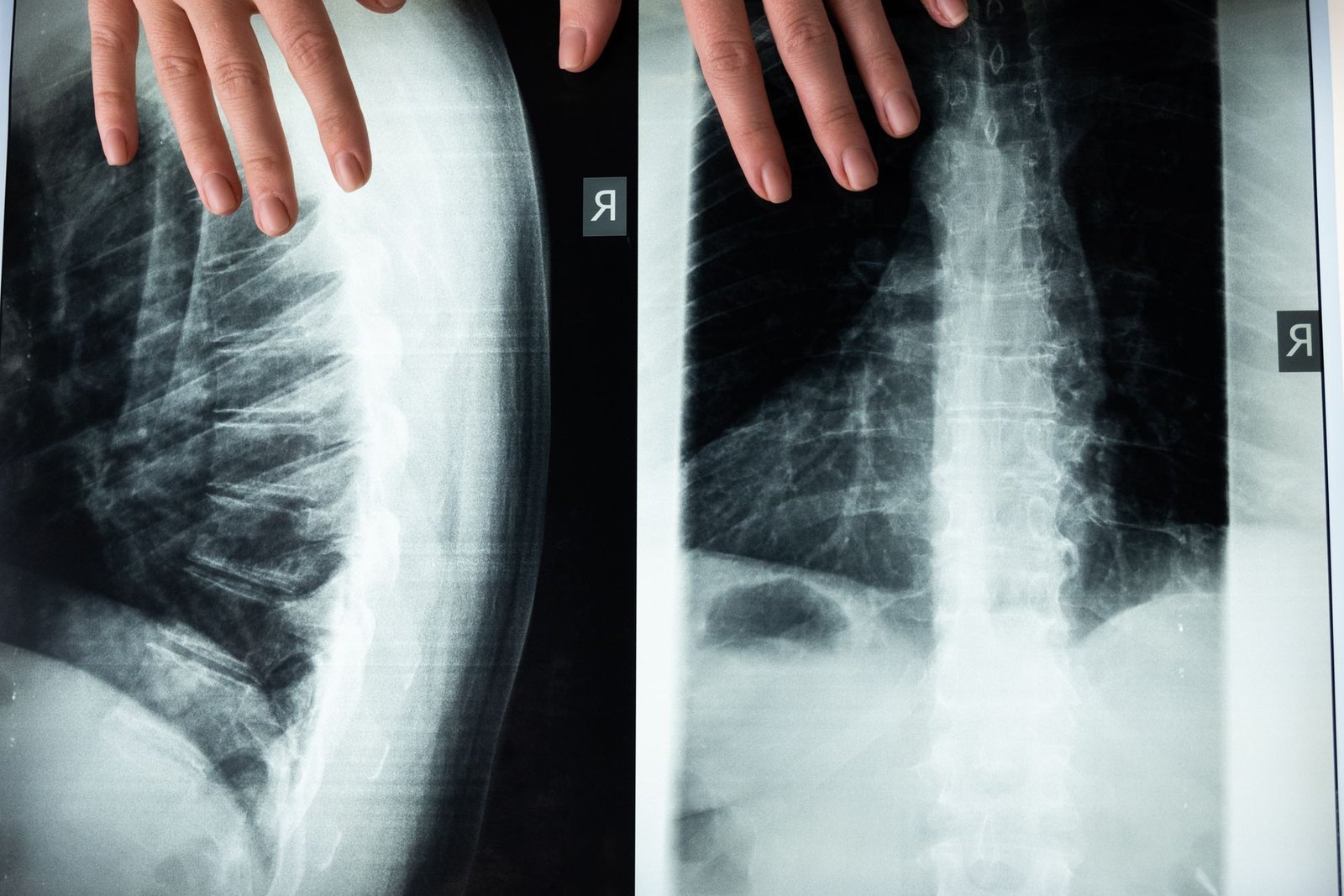Lower limb X-ray: Leg (Tibia/Fibula) care photograph